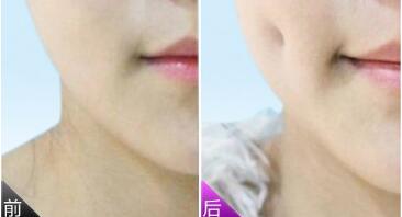 長沙單眼皮紋眼線應(yīng)該需要花多少錢(2023長沙單眼皮紋眼線參考價(jià)為：7091元)