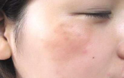 重慶針灸美白手術費用標準公開(2023重慶針灸美白參考價為：6519元)