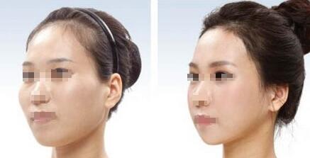 大連自體脂肪填充下巴大概要多少錢啊(大連時尚醫(yī)療美容門診部自體脂肪填充下巴參考價：5809元)