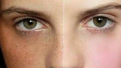 上饒麥格膨體隆胸2023報價詳情一覽(上饒維多利亞醫(yī)療美容麥格膨體隆胸參考價：5630元)