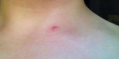 西安私處脫毛價(jià)格明細(xì)(2023西安私處脫毛參考價(jià)為：6612元)