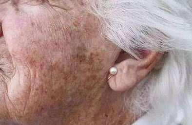 福建埋線改善面部松弛費用大致上是多少(2023福建埋線改善面部松弛參考價為：6234元)