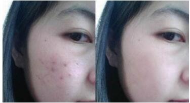 北京仿生眼袋回納術(shù)2023價格明細同步(2023北京仿生眼袋回納術(shù)參考價為：5950元)