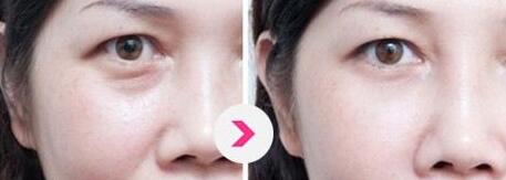 昆明激光治療細紋手術(shù)費用詳情信息(2023昆明激光治療細紋參考價為：5088元)