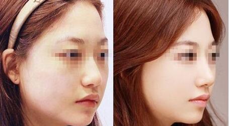 青島v提升面部手術價格貴不貴啊(2023青島v提升面部參考價為：5676元)