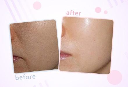 河南熱拉提祛口周紋整形優(yōu)惠價(jià)格表預(yù)先一覽(2023河南熱拉提祛口周紋參考價(jià)為：6683元)