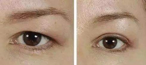 合肥妊娠紋線雕提升價(jià)格表2023全新參考詳情(2023合肥妊娠紋線雕提升參考價(jià)為：7263元)