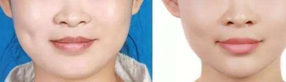 福州玻尿酸修復(fù)價目表明細(xì)上線(2023福州玻尿酸修復(fù)參考價為：6445元)