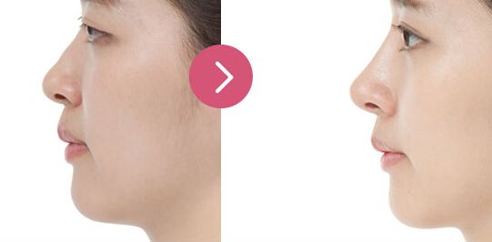 北京玻尿酸豐眼窩價格