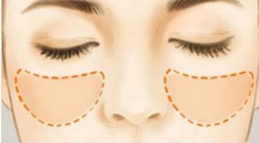 佛山眼周紋剝離術的價格清單(佛山順德中醫(yī)院整形科眼周紋剝離術參考價：5721元)