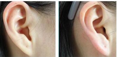 昆山不良重瞼矯正手術(shù)價(jià)格表同步一覽(2023昆山不良重瞼矯正參考價(jià)為：6008元)