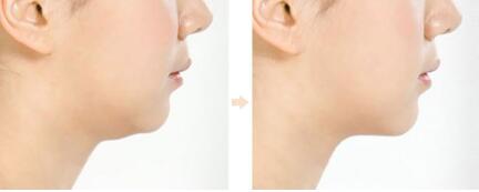 鞍山眼底紋打活細(xì)胞治療價(jià)目表清單明細(xì)(2023鞍山眼底紋打活細(xì)胞參考價(jià)為：6447元)