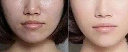 泰州曼特波隆下巴價位表明細(xì)一覽(泰州第一人民醫(yī)院整形科曼特波隆下巴參考價:4801元)