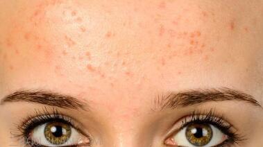 溫州黃金點(diǎn)陣微針射頻祛痘坑手術(shù)費(fèi)用查看(2023溫州黃金點(diǎn)陣微針射頻祛痘坑參考價(jià)為：6174元)