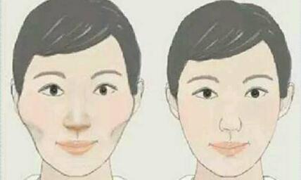 湛江法令紋填充玻尿酸一次通常要消費(fèi)多少錢(湛江熙施醫(yī)療美容門診部法令紋填充玻尿酸參考價(jià)：5000元)