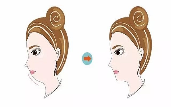 上海額頭拉皮除皺2023收費明細更新發(fā)布(上海歐萊美醫(yī)療美容醫(yī)院額頭拉皮除皺參考價：6976元)