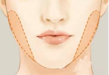 重慶上瞼提肌肌腱折疊矯正上瞼下垂需要治療費用多少(2023重慶上瞼提肌肌腱折疊矯正上瞼下垂參考價為：6963元)