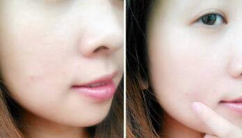 韓國激光脈沖去黑頭費用你知道多少(北京韓國完美美容整形醫(yī)院激光脈沖去黑頭參考價：4904元)