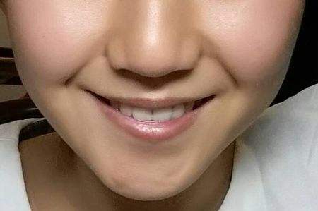 江門微創(chuàng)面部吸脂術(shù)的費用多少錢查詢?nèi)缦?2023江門微創(chuàng)面部吸脂術(shù)參考價為：6131元)