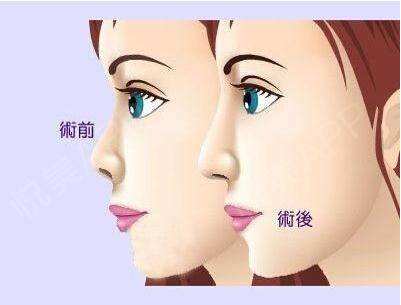 懷化眼袋重處理價格