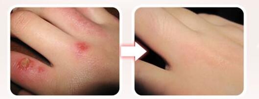 鄭州隆鼻綜合2023價格(2023鄭州隆鼻綜合參考價為：6451元)