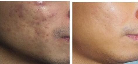 廣西C8凈膚鐳射掃斑王價格是多少費用啊(廣西玉林華美整形美容醫(yī)院C8凈膚鐳射掃斑王參考價：3290元)