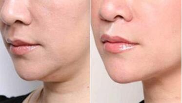 唐山注射填充川字紋的費(fèi)用清單(2023唐山注射填充川字紋參考價(jià)為：6752元)