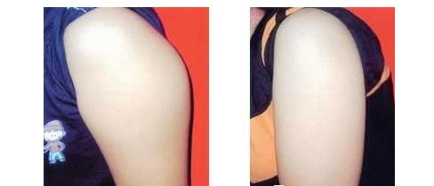 九江上頜骨內(nèi)推手術(shù)價(jià)目表明細(xì)查詢(2023九江上頜骨內(nèi)推手術(shù)參考價(jià)為：6425元)