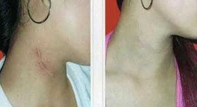 長春玻尿酸注射豐唇術價目表驚喜爆出(2023長春玻尿酸注射豐唇術參考價為：5629元)