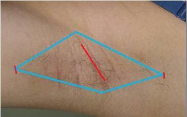 廣州皮秒祛除雀斑大概價(jià)格是多少(2023廣州皮秒祛除雀斑參考價(jià)為：6706元)