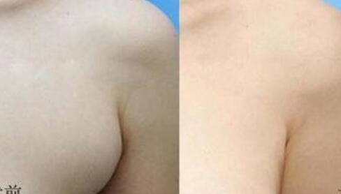 寧波激光除面部皺紋要價(jià)格是多少費(fèi)用啊(2023寧波激光除面部皺紋參考價(jià)為：6919元)