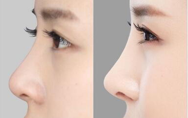 山東腰腹射頻溶脂治療價(jià)格詳細(xì)版本一覽(2023山東腰腹射頻溶脂參考價(jià)為：6523元)