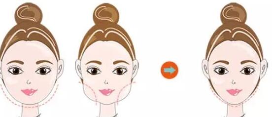 鄭州眼部吸脂手術(shù)一般需要治療費用是多少(2023鄭州眼部吸脂手術(shù)參考價為：7190元)