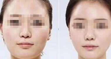 上海E光去除動態(tài)細紋價目表(手術(shù)收費標準)(2023上海E光去除動態(tài)細紋參考價為：7133元)