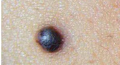 北京鼻唇溝注射玻尿酸收費價格表查看(2023北京鼻唇溝注射玻尿酸參考價為：5701元)