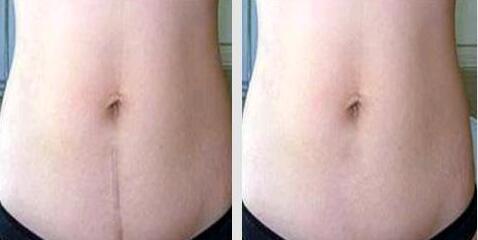 齊齊哈爾光纖熱塑微創(chuàng)溶脂可能需要多少錢(2023齊齊哈爾光纖熱塑微創(chuàng)溶脂參考價為：6547元)