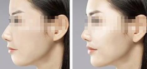 大連韓式半永久睫毛線治療價目表公布(2023大連韓式半永久睫毛線參考價為：6623元)