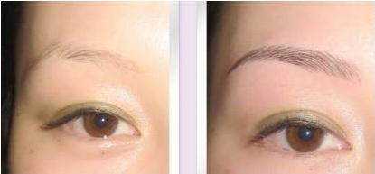 鄭州肥厚鼻尖鼻翼矯正術(shù)收費標準圖表查看(2023鄭州肥厚鼻尖鼻翼矯正術(shù)參考價為：5728元)