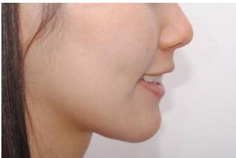武漢面部假體隆下巴的價(jià)格表震撼發(fā)布(2023武漢面部假體隆下巴參考價(jià)為：6311元)