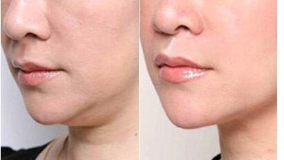 中山不良隆胸修復(fù)治療費用清單預(yù)覽(2023中山不良隆胸修復(fù)參考價為：7135元)