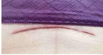 中山3d臉部提升治療價格表收費詳情標準(2023中山3d臉部提升參考價為：6813元)