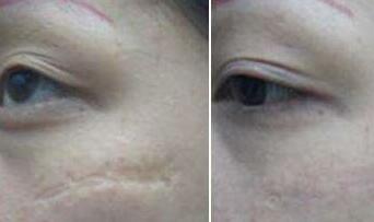 南京射頻祛除靜態(tài)紋治療價格表分享(2023南京射頻祛除靜態(tài)紋參考價為：6237元)