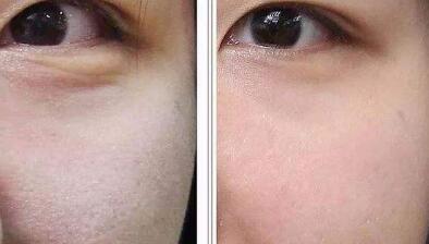 深圳伊維蘭注射隆下巴的價格大概需要多少錢合適(2023深圳伊維蘭注射隆下巴參考價為：5387元)