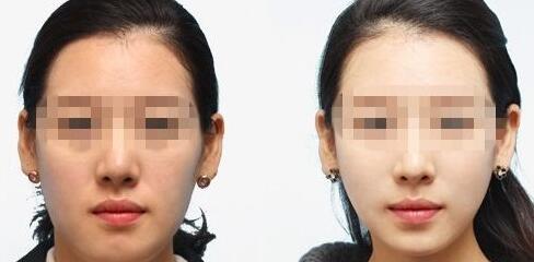 湖南超聲炮去口周紋價(jià)格表收費(fèi)(湖南長(zhǎng)沙至雅醫(yī)美超聲炮去口周紋參考價(jià)：6548元)