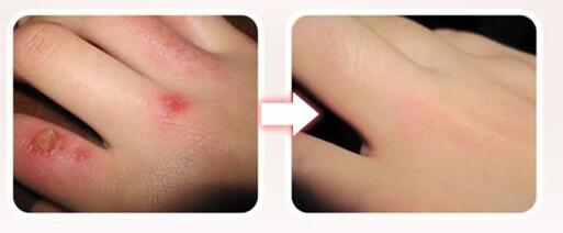 河北去除雀斑費(fèi)用趨勢(shì)圖上線(2023河北去除雀斑參考價(jià)為：6695元)