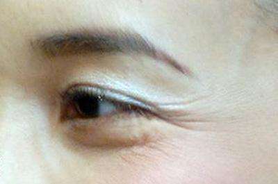 上海黃金點陣射頻祛痘坑費用2023預先一覽(2023上海黃金點陣射頻祛痘坑參考價為：5934元)