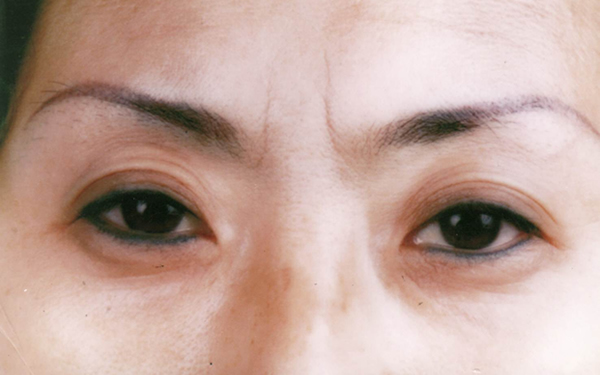 東莞熱拉提去除抬頭紋2023價(jià)格表更新(2023東莞熱拉提去除抬頭紋參考價(jià)為：6608元)