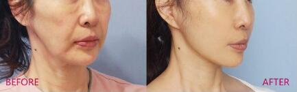 北京激光去除頸紋價格