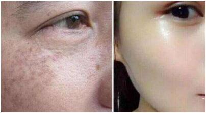 黑龍江膠原蛋白注射去痘價(jià)格高不高呀(2023黑龍江膠原蛋白注射去痘參考價(jià)為：6939元)