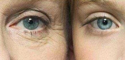 南寧鐳射去痘坑價格